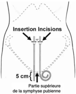 Figure 3 - Schéma d’un patient couché sur le dos  montrant la manière dont le site d’insertion du cathéter  et l’emplacement du manchon profond sont déterminés  afin  d’obtenir  une  position  pelvienne  correcte  de  l’extrémité du cathéter