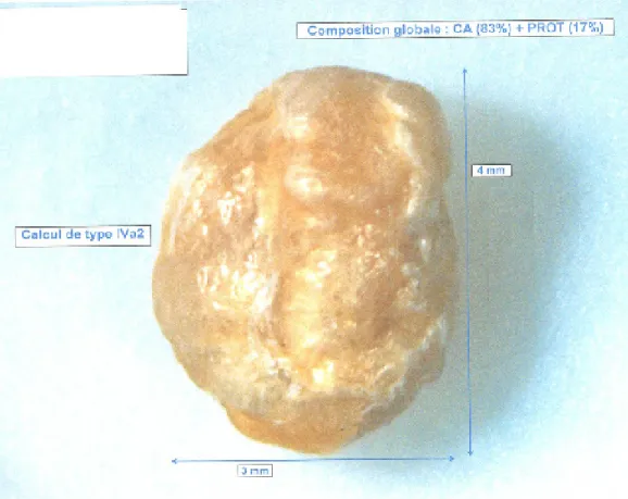 Fig. 1. Lithiase extraite de la lumière du cathéter péritonéal
