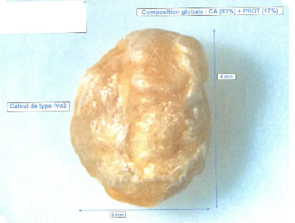 Fig. 1. Lithiase extracted from the peritoneal catheter lumen