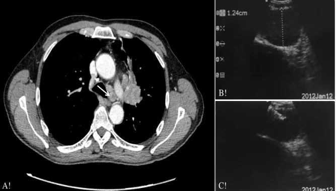 Figure 1. Imaging of EBUS lymph node identification and puncture 