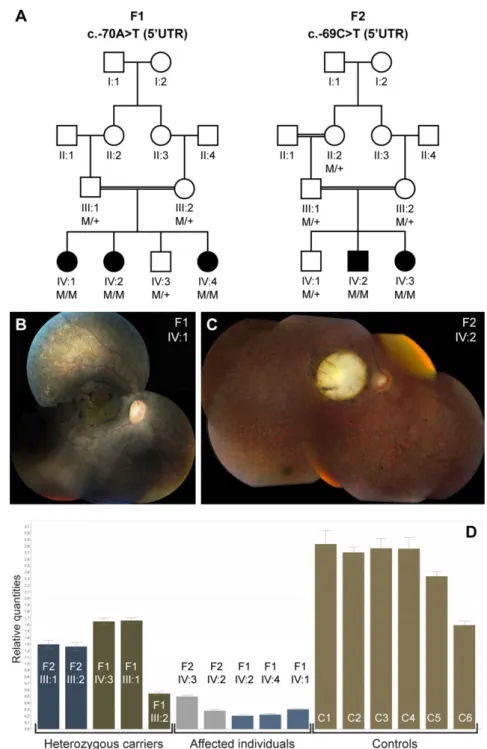 Figure 1. Segregation analysis, associated phenotype, and mRNA quantification of the NMNAT1 5  UTR mutations