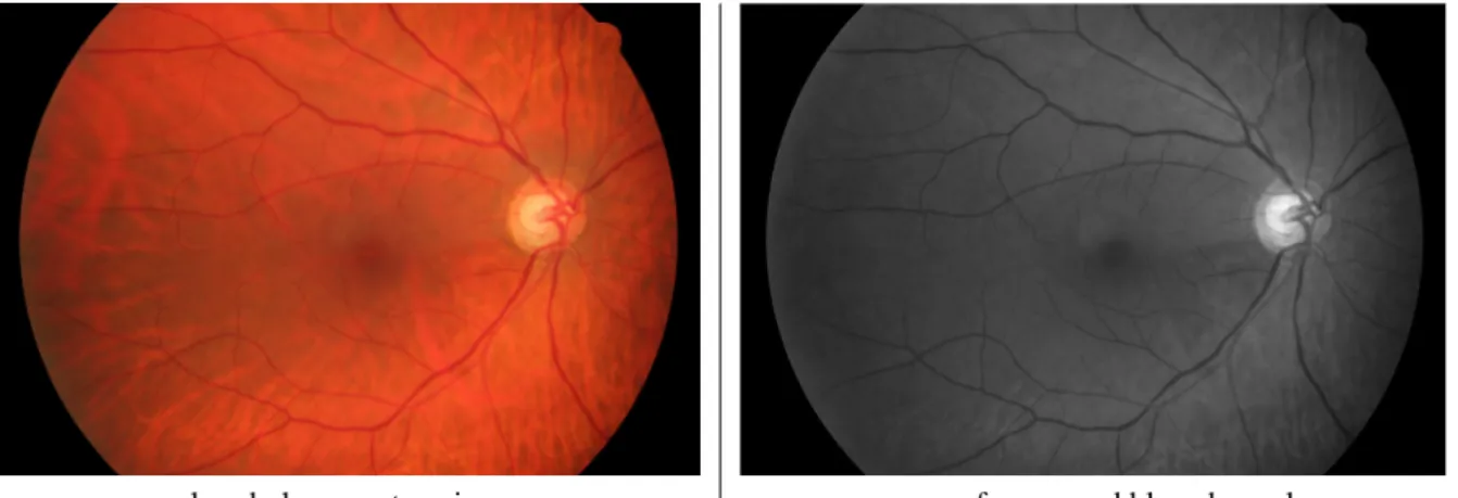 Figure 1. Example of a colored glaucomatous image and its mean of green and blue channels