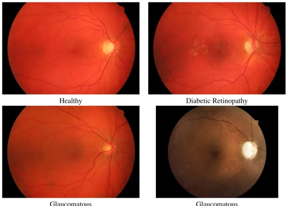 Figure 3. Samples from our database: non-Glaucomatous images in the first row and Glaucomatous images in the second row