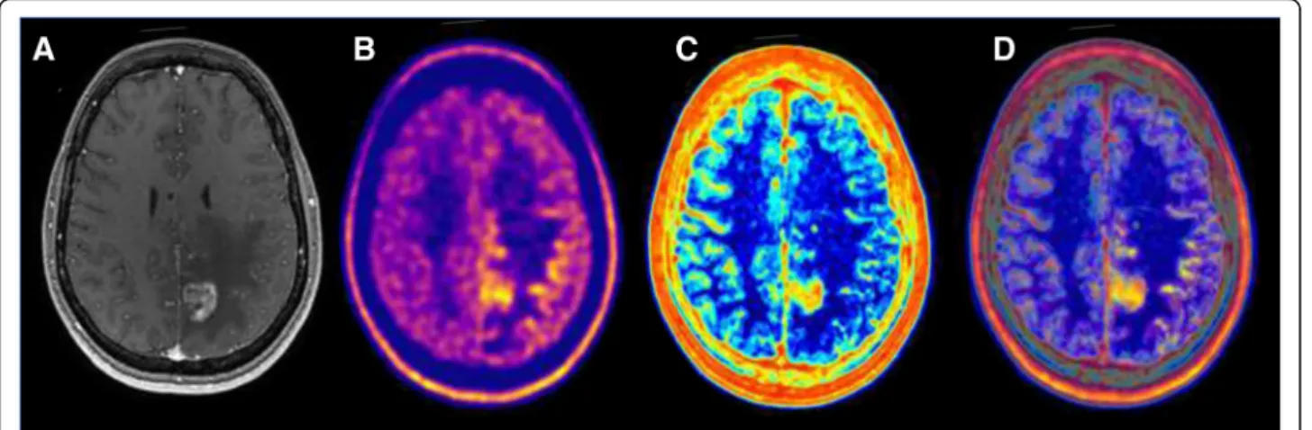 Fig. 4 Multimodal image-guided management using artificial intelligence in glioblastoma