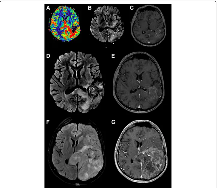 Fig. 2 Detection of a potential hyperprogression in a patient with glioblastoma. This case illustrates the potential risk of hyperprogression.