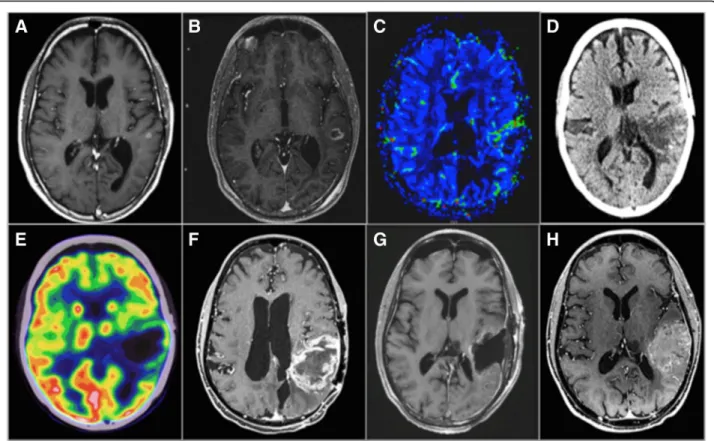 Fig. 3 Multimodal image-guided management in a PD-1, PD-L1, TILs glioblastoma. This case illustrates the potential interest of pre-