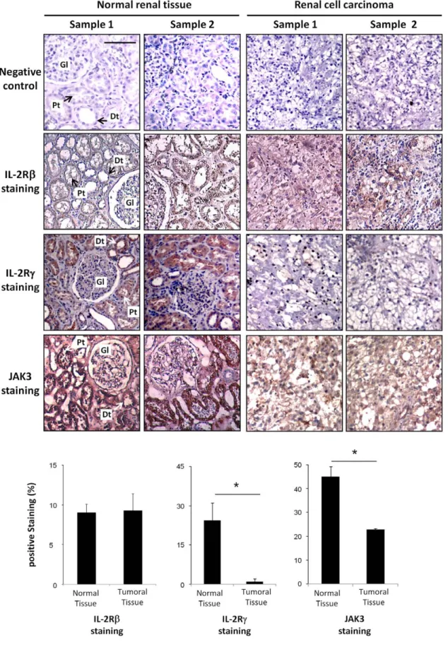 Figure 2. Immunohistochemical staining for IL-2Rb, IL-2Rc and JAK3 in normal and neoplastic kidney specimens