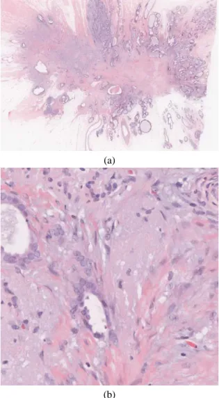 Fig. 2. (a) Whole Slide Image at resolution x1 (b) Sample image at resolution x40 out of over 2000 tiling the histopathological image