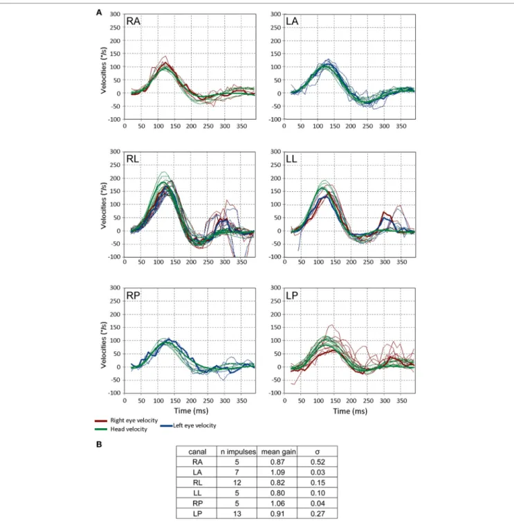 FigUre 5 | Video head impulse test (VHIT) responses from a 3-month-old child with no pathology