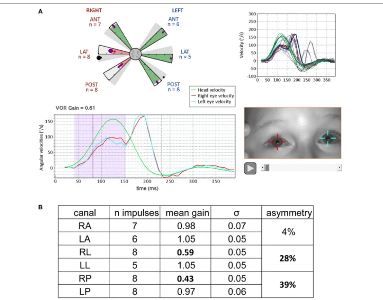 FigUre 6 | Results from video head impulse test (VHIT) performed on a 9-year-old child referred for an acute episode of vertigo lasting for several days (same  formats as Figures 3 and 5, with analysis of the upper part of Figure 4)