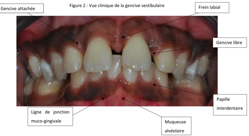 Figure 2 : Vue clinique de la gencive vestibulaire 