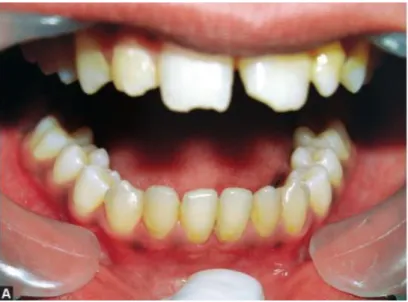 Figure 8 : Photo endo-buccale d'un patient dyslexique ayant une parafonction de type onychophagie  Cette habitude a entrainé une fracture amélaire de ses incisives 