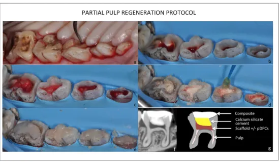 Figure 11 -  Description of the partial pulp regeneration model. After anesthesia, ultrasonic scaling to remove calculus  accumulated on teeth (a)