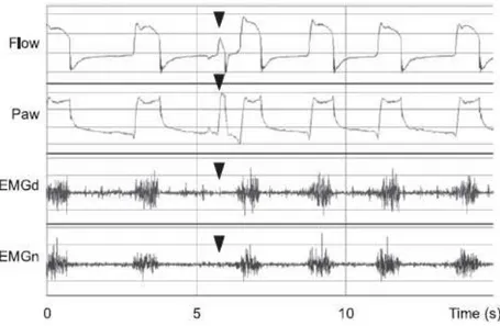 Figure 5 : Représentation de la détection d’un déclenchement du ventilateur (visible sur les courbes de débit et  de pression) sans effort inspiratoire du patient (visible sur les EMG) en mode AI + PEP : Tiré de Carteaux et al.,  2012, p