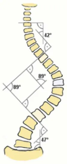 Figure 1: Mesure de l'angle de Cobb, tirée de Wikipédia, 2014.