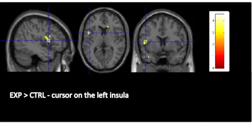 Fig.  9:  MRI  results:  GMV  comparison  EXP  >  CTRL  obtained  by  the  VBM  method  (p<0.005,  uncorrected)
