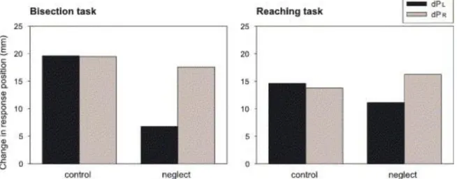 Fig. 3: a lower score in mm indicates less influence from the related cylinder ( d P l  -&gt; left cylinder  d P r  -&gt; right  cylinder); normal subjects are influenced equally by the left and right cylinders