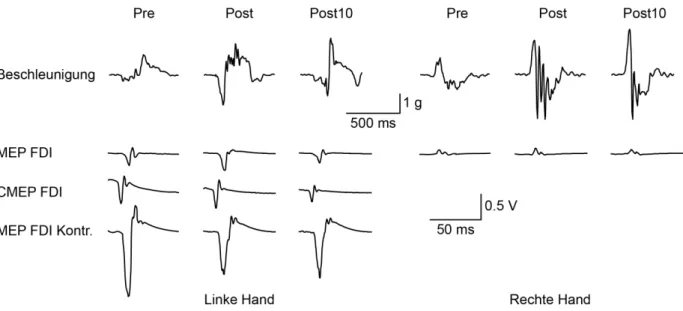 Abb. 5: Beschleunigungskurven und Amplituden der im M. interosseus dorsalis I (FDI) evozierten Potentiale der linken und  rechten  Hand  eines  einzelnen  Probanden  vor  (Pre),  nach  (Post)  dem  Training  und  zehn  Minuten  nach  der  Post-Messung  (Po