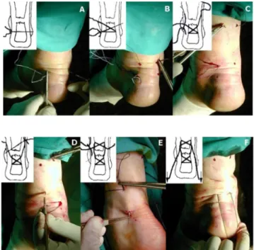 Figure 3 : Chirurgie percutanée, tiré de :  http://ajs.sagepub.com/content/33/9/1369/F2/g raphic-3.large.jpg