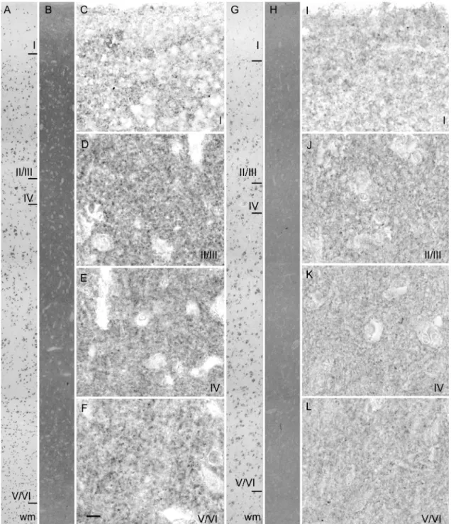 Figure 2. Immunohistological detection of VGLUT1 in the prefrontal cortex of a representative control subject (B- (B-F)  and  an  AD  patient  (H-L)