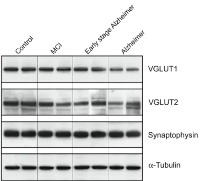 Figure  3.  VGLUT1,  VGLUT2,  synaptophysin  and  α-tubulin  levels  assessed  by  Western  blot  in  the  prefrontal  cortex of controls, MCI, early stage Alzheimer or AD patients
