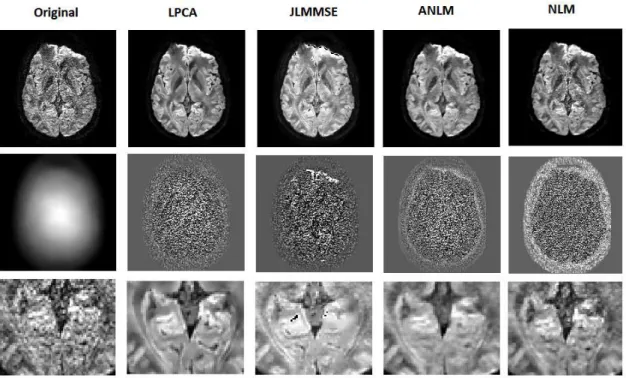Figure 7. Example results on a clinical dataset. First row-Left to right: Original noisy data, LPCA  results,  JLMMSE  results,  ANLM  results  and  NLM  results