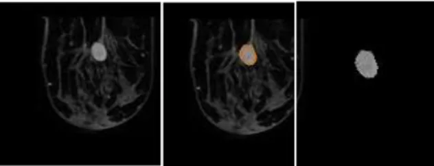 Figure 2: Original MRI, segmented benign lesion and lesion  extracted respectively from left to right