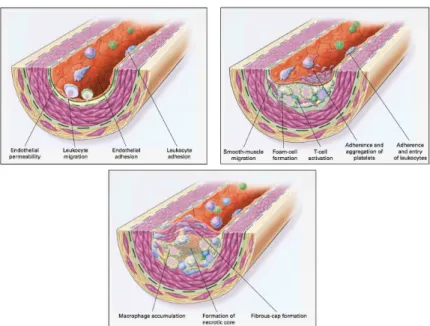 Figure 1: Early events of atherosclerosis. LDL penetrates in the intima, thus triggering an inflammatory process
