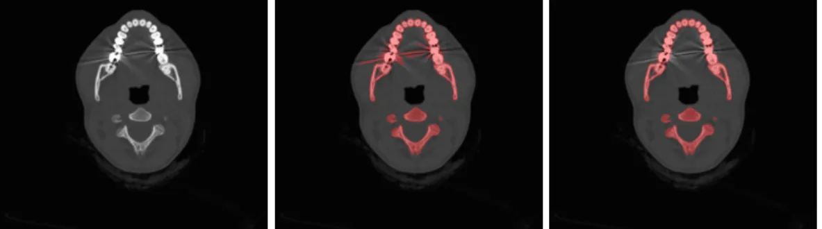 Figure 2 – Left: reference gray-level image. Middle: pre-segmentation of the bone using a threshold technique (red)