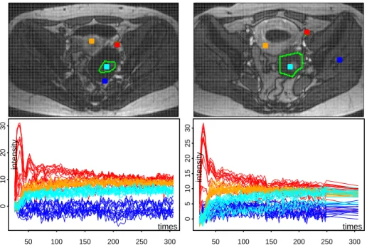 Figure 3: DCE-MRI image sequences of two female pelvis with ovarian tumors - each column shows one sequence