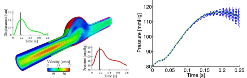 Figure 7: Left: snapshot of the velocity field (left) inside the idealized AAA, the curves show outlet pressure and displacements of the aneurysm wall