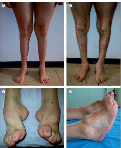 Figure 16 : Atrophies musculaires péronières et déformations des pieds chez des patients atteints de CMT 1A  (Pareyson and Marchesi, 2009)