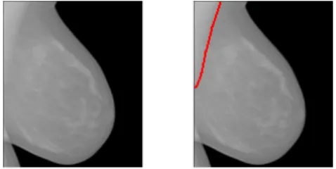 Figure 4 -  Délimitation entre muscle et sein peu marquée 