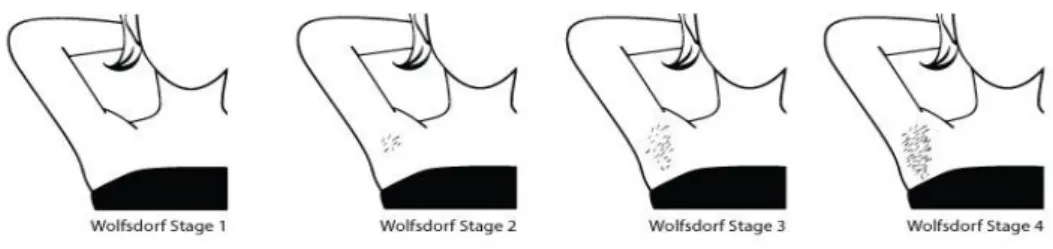 Figure 1: Wolfsdorf stages of axillary hair conforming to our pubertal stages. 