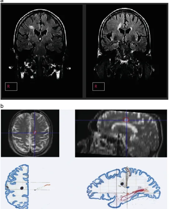 Fig. 1. (a) Patient′s MRI coronal section; lesion creates a disconnection between right posterior SMA and caudate/putamen