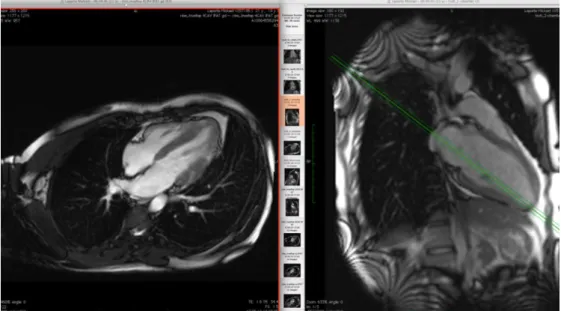 Figure 18. L’image sagittale de droite permet de choisir une coupe axiale optimale 