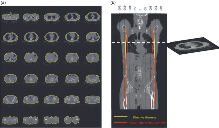 Figure 2. Comparison of effective diameter and D w  for a patient data set. A threshold of −383 HU was used to remove the patient table for every 10th image in the data set