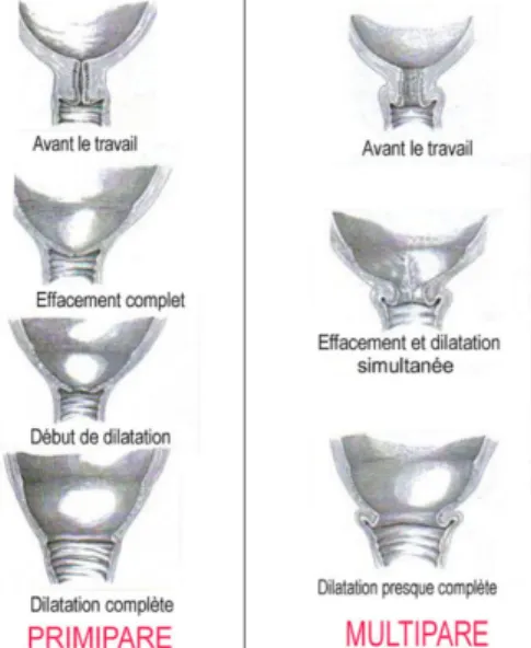 Figure 1 - Comparaison des processus d’effacement et de dilatation du col chez la primipare et chez la  multipare