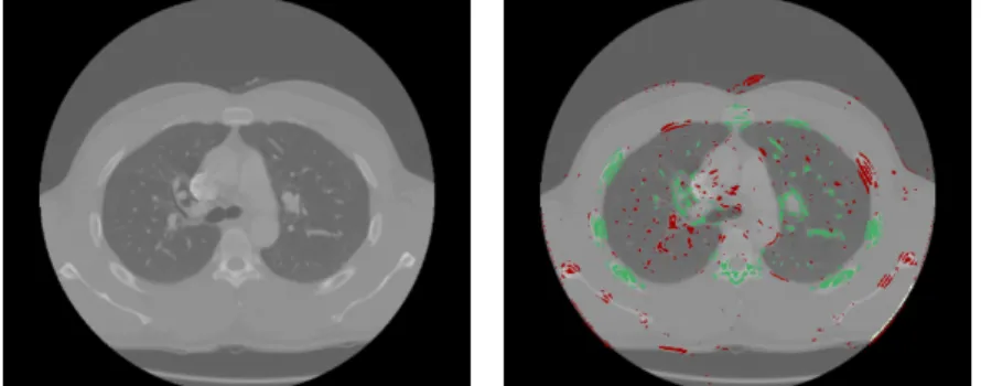 Figure 4. Examples of salient regions detected in lung CT scans at various scales.