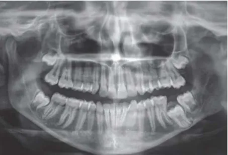 Figure 20 : Radiographie panoramique d'une seconde molaire mandibulaire incluse chez une  adolescente de 15 ans (SHARMA ET NARAIN, 2014) (107) 
