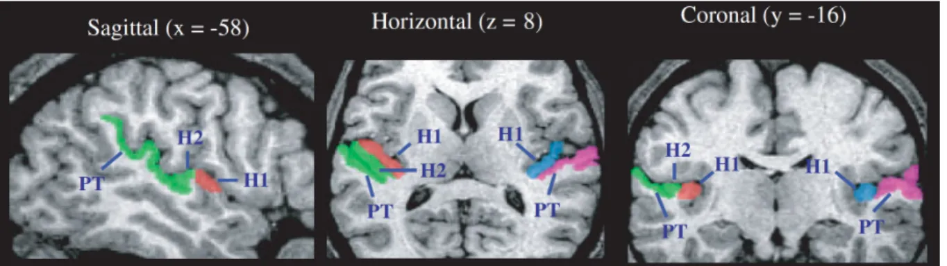 Figure I.1 3 : Description anatomique du gyrus de Heschl et du planum temporale. 