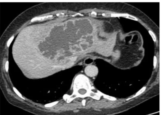 Figure 4 : Scanner au temps portal montrant un abcès hépatique à Klebsiella pneumoniae [4]
