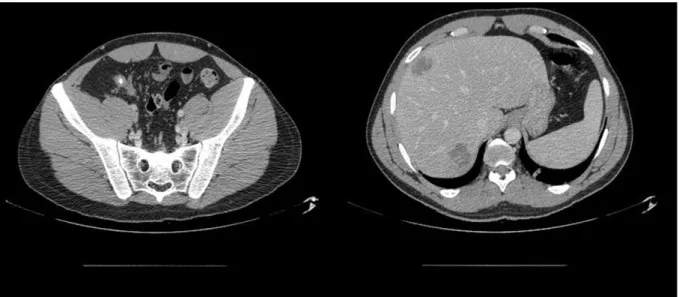 Figure 5 : TDM à l’entrée, Image de gauche: coupe transversale passant par l’appendice montrant un  appendice augmenté de volume et un stercolithe appendiculaire