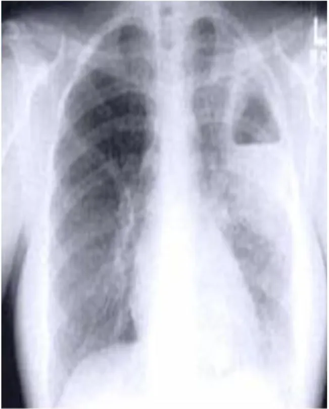 Figure 7 : Abcès pulmonaire gauche avec le niveau hydro -aérique [225]. 