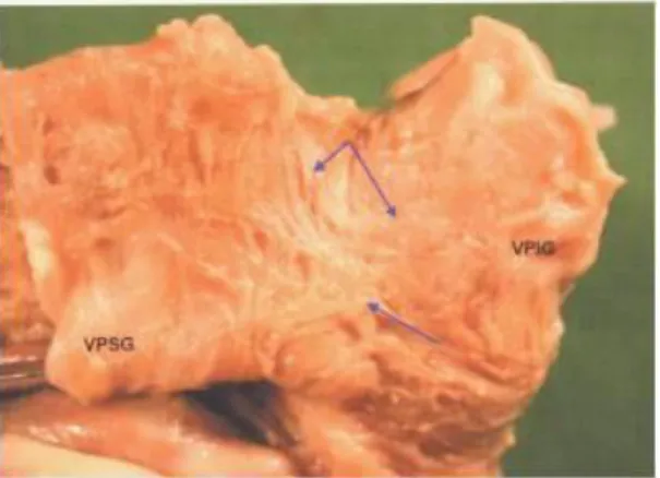 Fig 24. Vue montrat des faisceaux musculaires reliant   les extensions des deux veines pulmonaires gauches