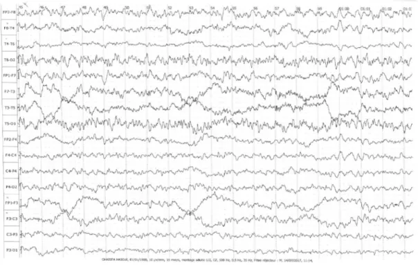 Figure  1 :  EEG  objectivant  une  activité  de  fond  symétrique  bien  organisée  comportant un rythme alpha peu ample, diffus