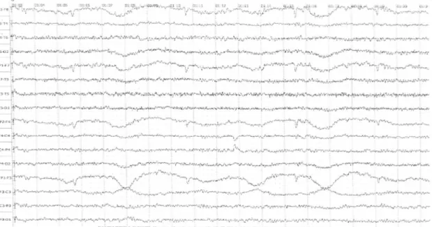 Figure  3 :  EEG  objectivant  une  activité  de  fond  dans  la  limite  de  la  normale