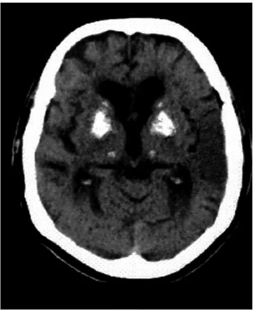 Figure  1 :  TDM  cérébrale:  calcifications  bilatérale  des  noyaux  gris centraux avec une hypodensité temporale gauche 