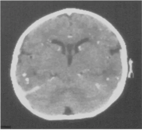 Figure 5: L'infection à CMV chez un nourrisson de sexe masculin de 10mois avec une  transmission transplacentaire