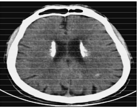 Figure 11: Tomodensitométrie sans injection de produit de contraste en 